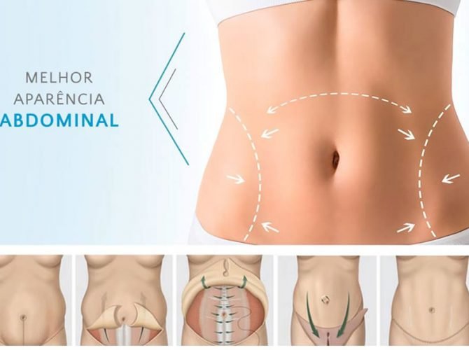indicações de abdominoplastia em sinop