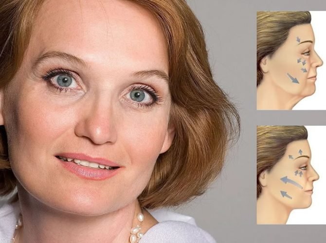 lifting facial em sinop