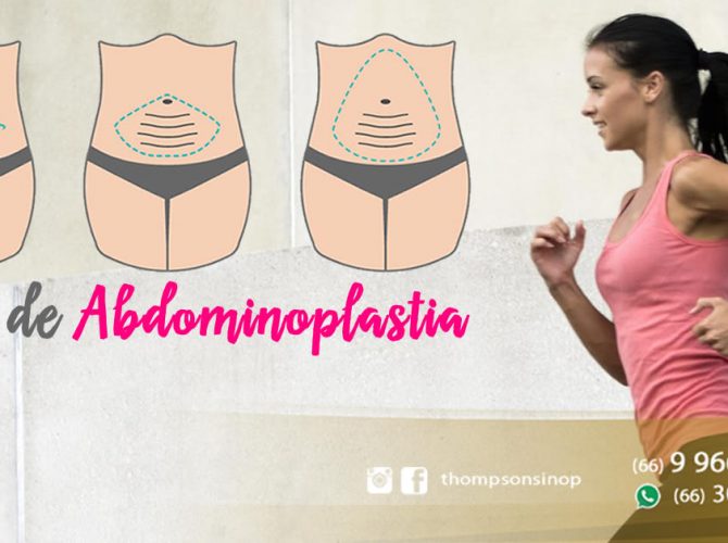 Tipos de Abdominoplastia