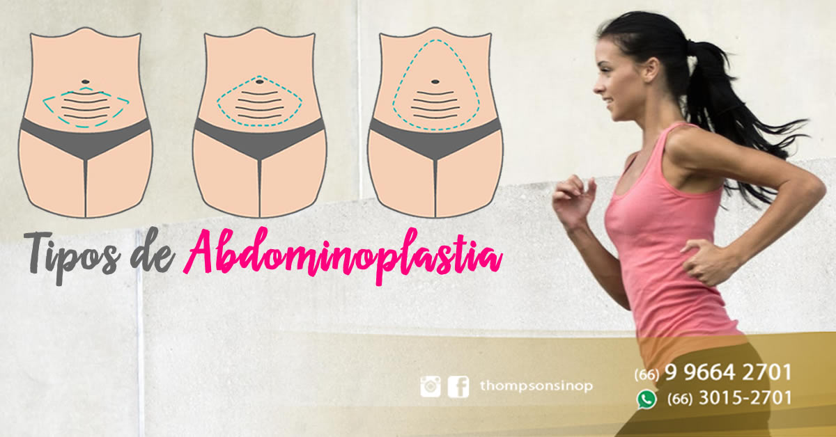 Tipos de Abdominoplastia