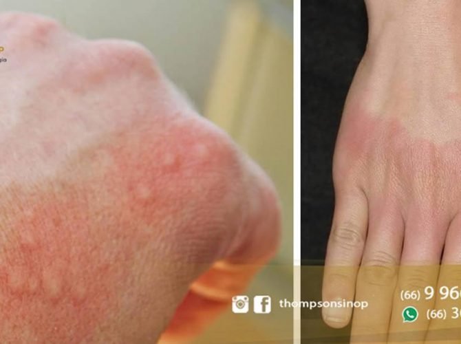 tratamento da dermatite de contato em sinop mt